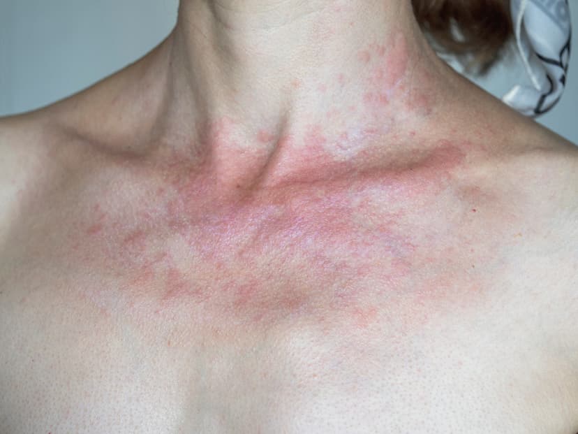 Dermatitis Atópica
